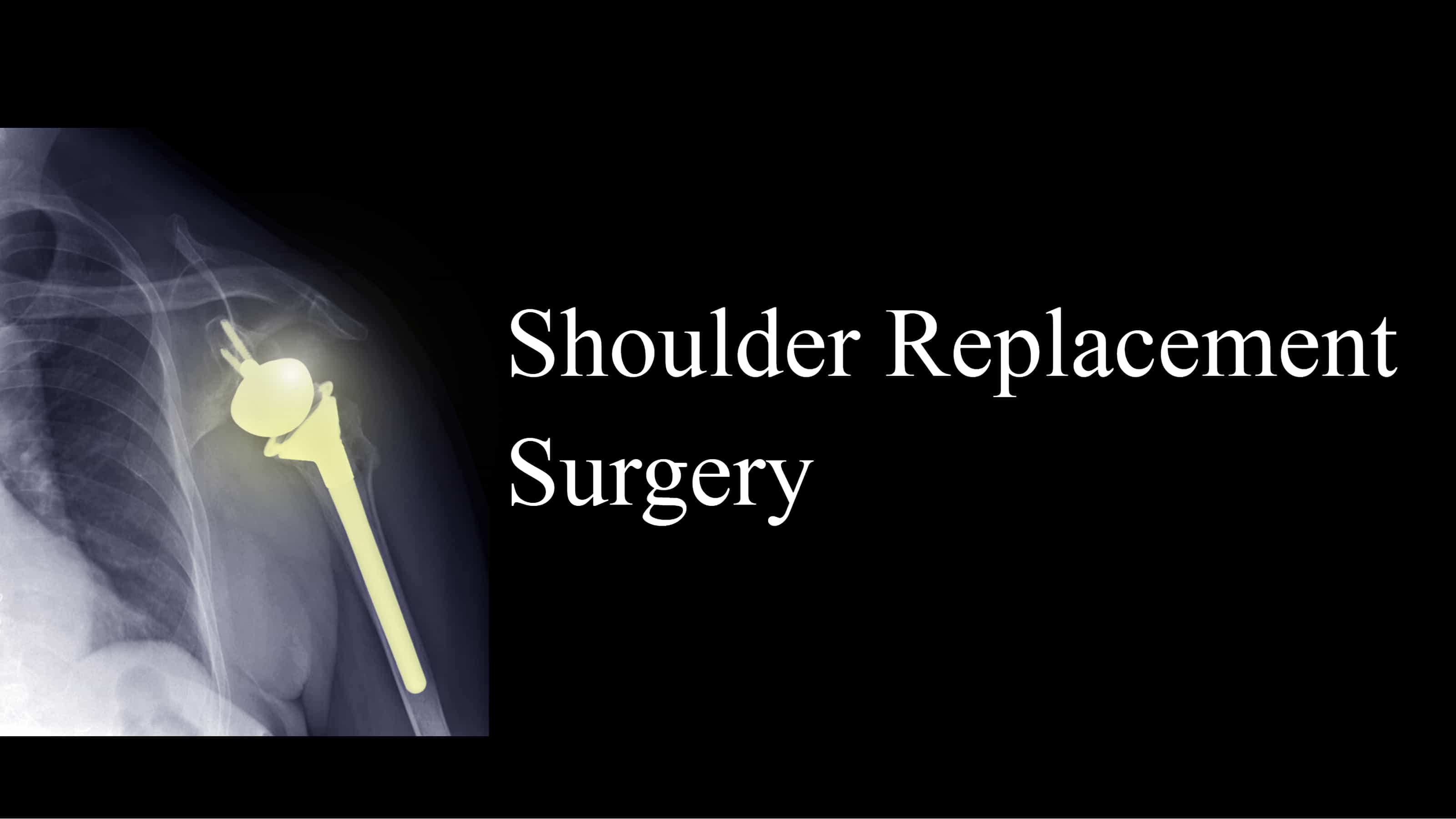 Shoulder replacement surgery