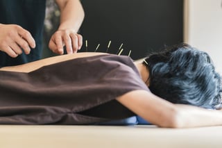 dry needling vs acupuncture