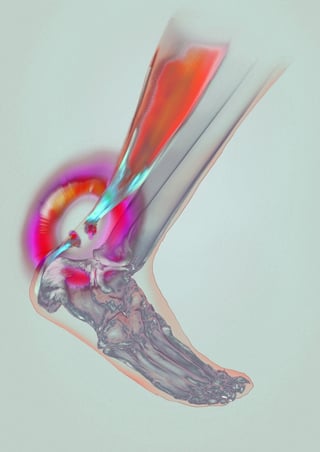 achilles-tendon-rupture