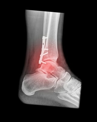 ankle_fracture_injury
