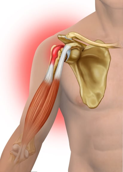 biceps tendinitis2.jpg