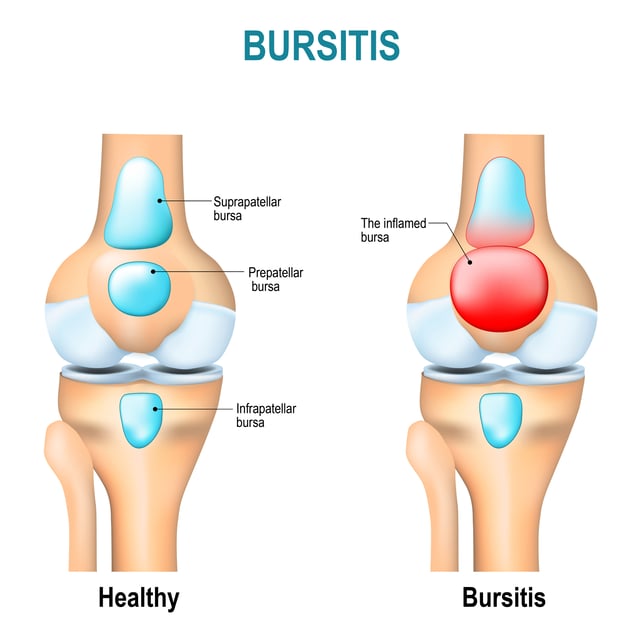 Bursitis What Is It, Causes, and Areas of the Body Affected