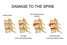 herniated disc of the neck 