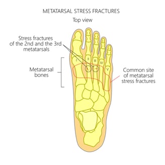 common locations of where stress fractures reside in the foot