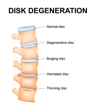 disk degeneration examples