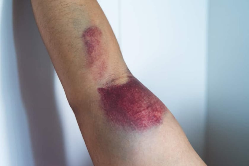 distal biceps tendon tear 2-1