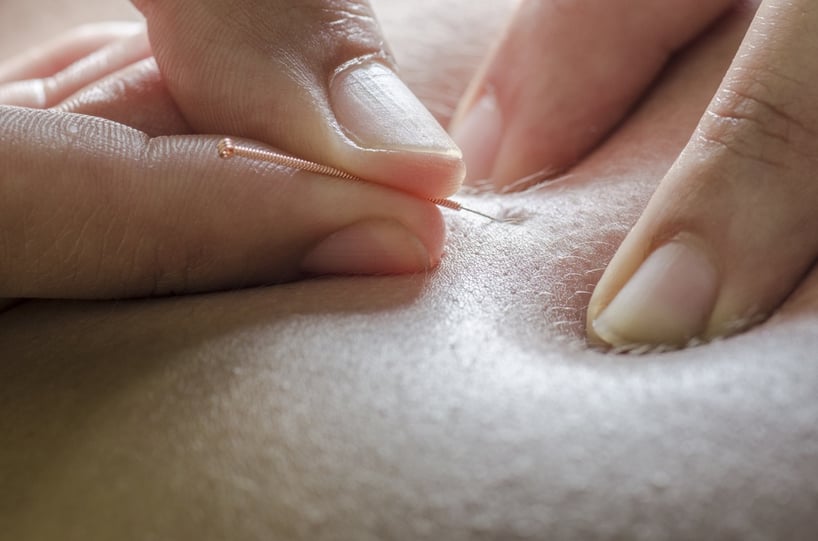 Dry Needle Therapy: How Does It Work?