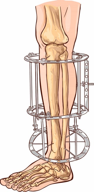 external-fixation-leg