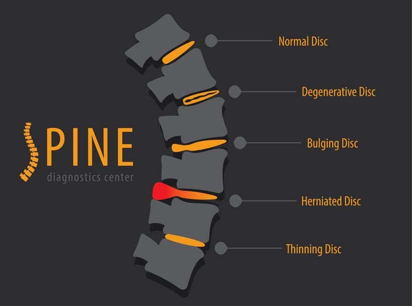 herniated disc treatment options