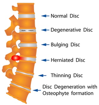 herniated disc names