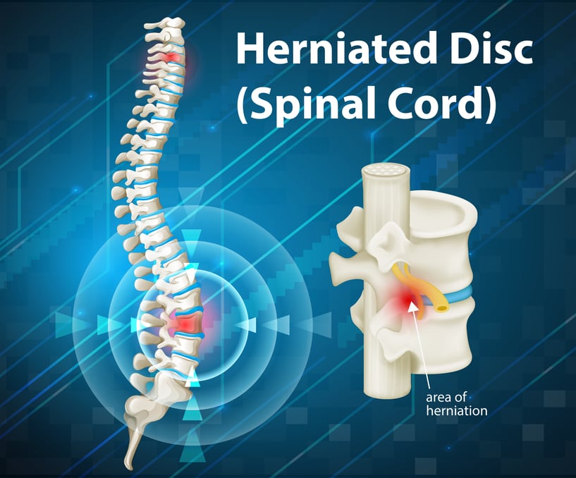 herniated disc signs and symptoms