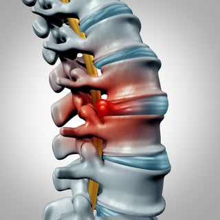 what is a herniated disc 