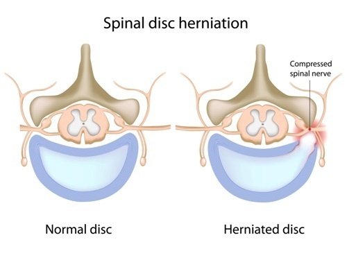 herniated disc example