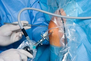 knee-arthroscopy-surgery