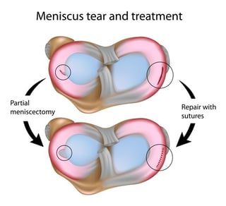 meniscus tear and injury