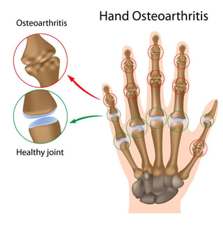 osteoarthritis-hand-drawing.jpg