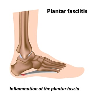 plantar_fascia_fasciitis