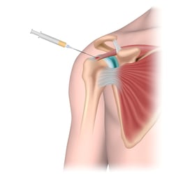 common injuries for prp therapy 