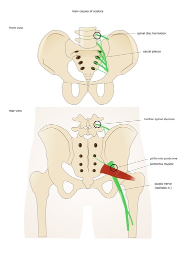 sciatica main causes