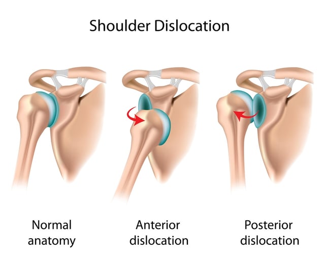 shoulder_dislocations_types