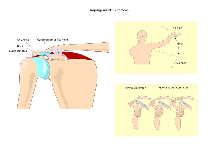 shoulder_impingement_diagram