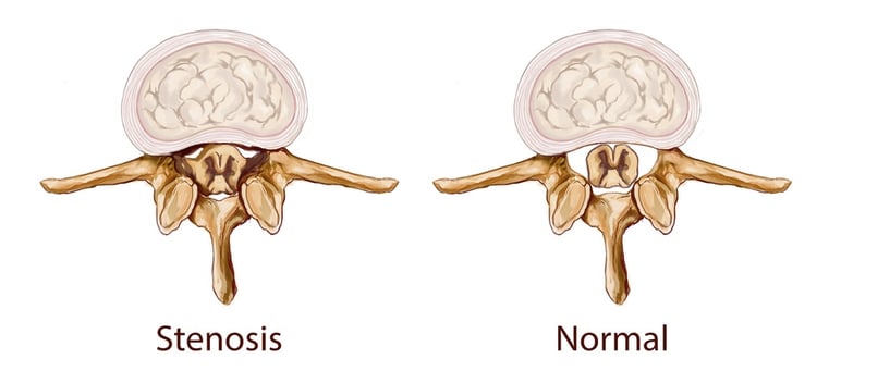 spinal stenosis example