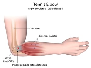 tennis elbow tendonitis