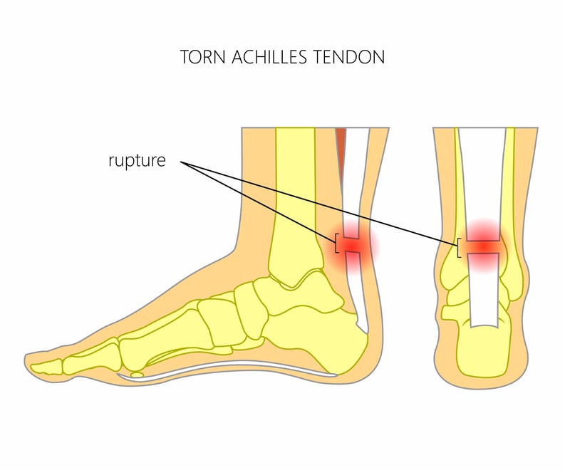 torn achilles ijn Texas