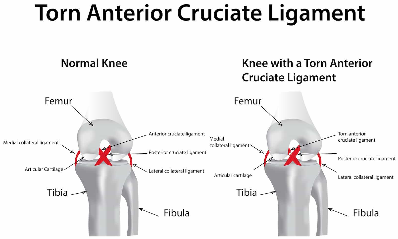acl tear symptoms acl tear symptoms
