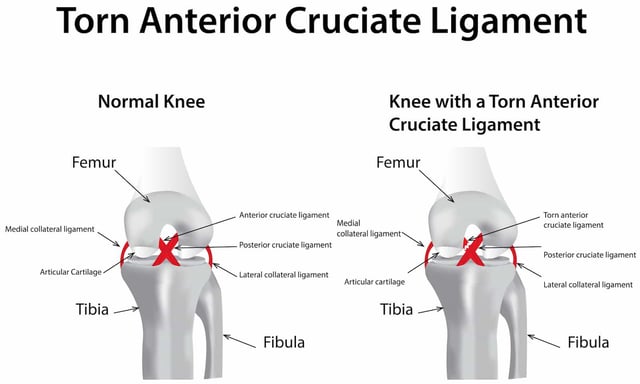 Everything You Need to Know About Anterior Cruciate Ligament (ACL