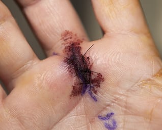 trigger-finger-release-surgery