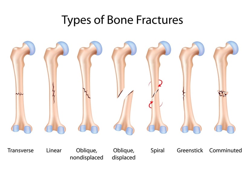 types-of-bone-fracture