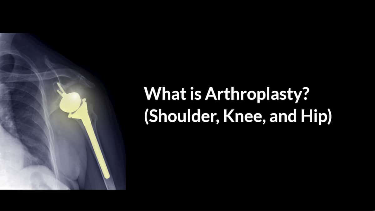 what is arthroplasty1