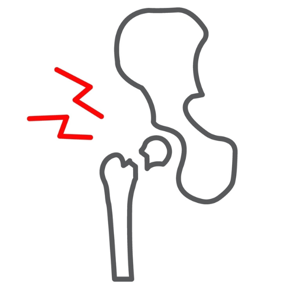 Proximal Femur Hip Fracture