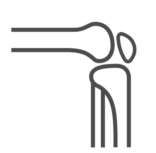Kneecap Instability