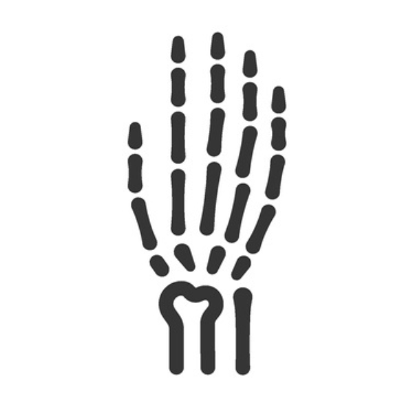 4th & 5th Metacarpals (Hand) Fracture