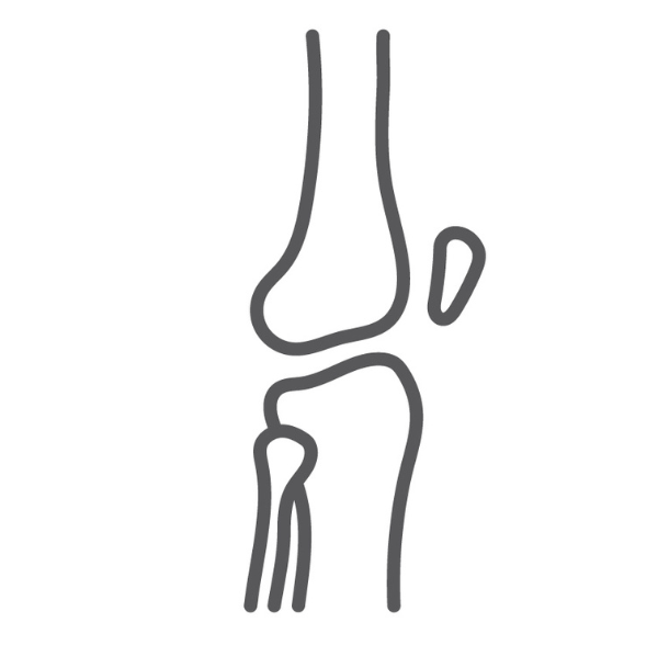 Tibia Plateau Fracture