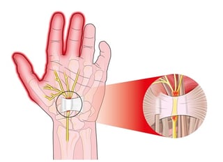 The carpal tunnel houses the median nerve. When it's compressed, pain and numbness can lead to carpal tunnel syndrome.