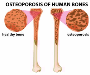graphicstock-diagram-showing-osteoporosis-of-human-bones-illustration_rGN2NcA3e_L