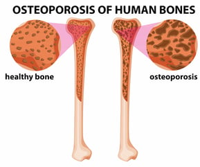 graphicstock-diagram-showing-osteoporosis-of-human-bones-illustration_rGN2NcA3e_L