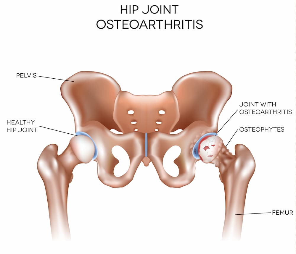 hip osteoarthritis