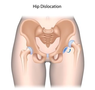 Hip Pain: Causes, Symptoms, Treatment and Exercises