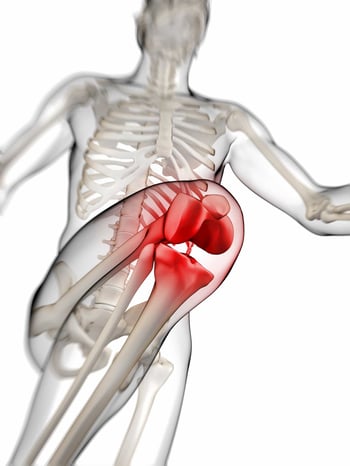 Any kind of inflammation, misalignment or injury to the kneecap can result in runner's knee.