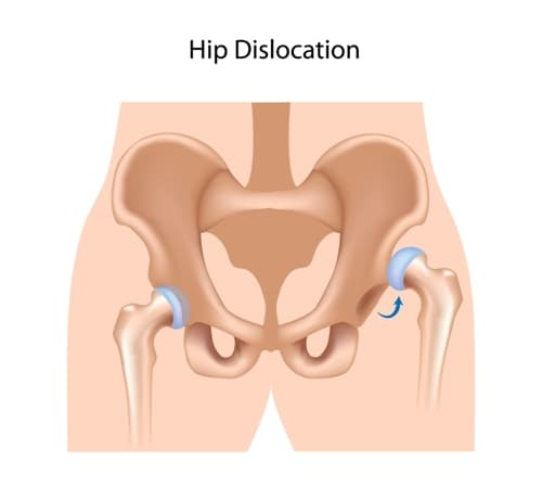 hip dislocation