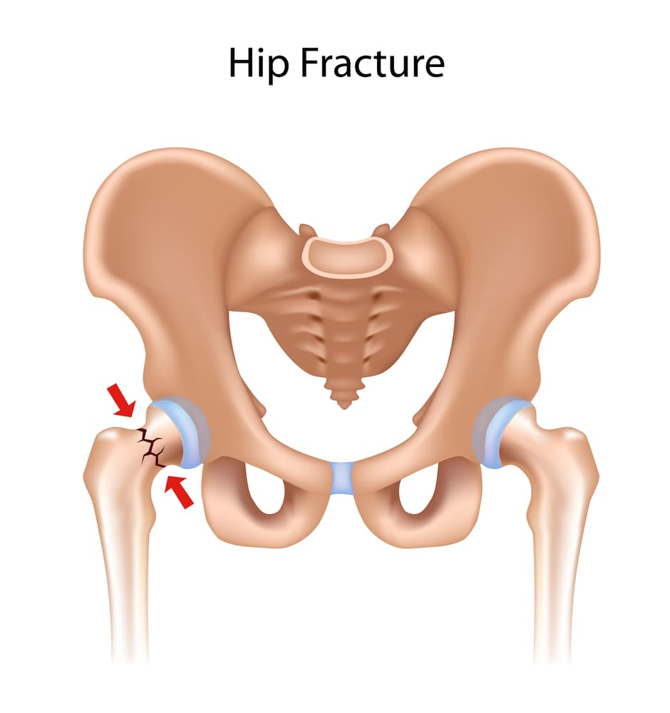 hip fracture