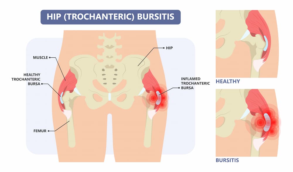 hip bursitis