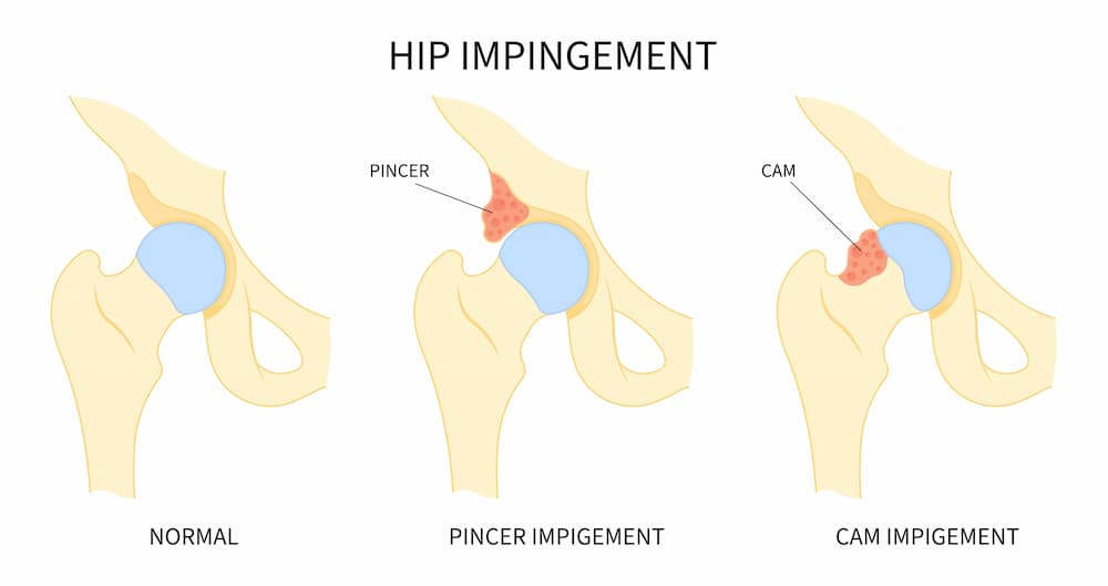 Femoral Acetabular Impingement