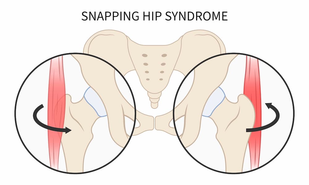 snapping hip syndrome