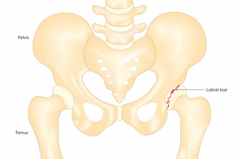 hip labral tear