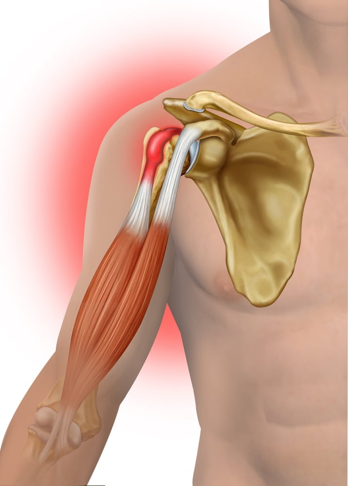 Biceps Tendinitis: Causes and Risk Factors
